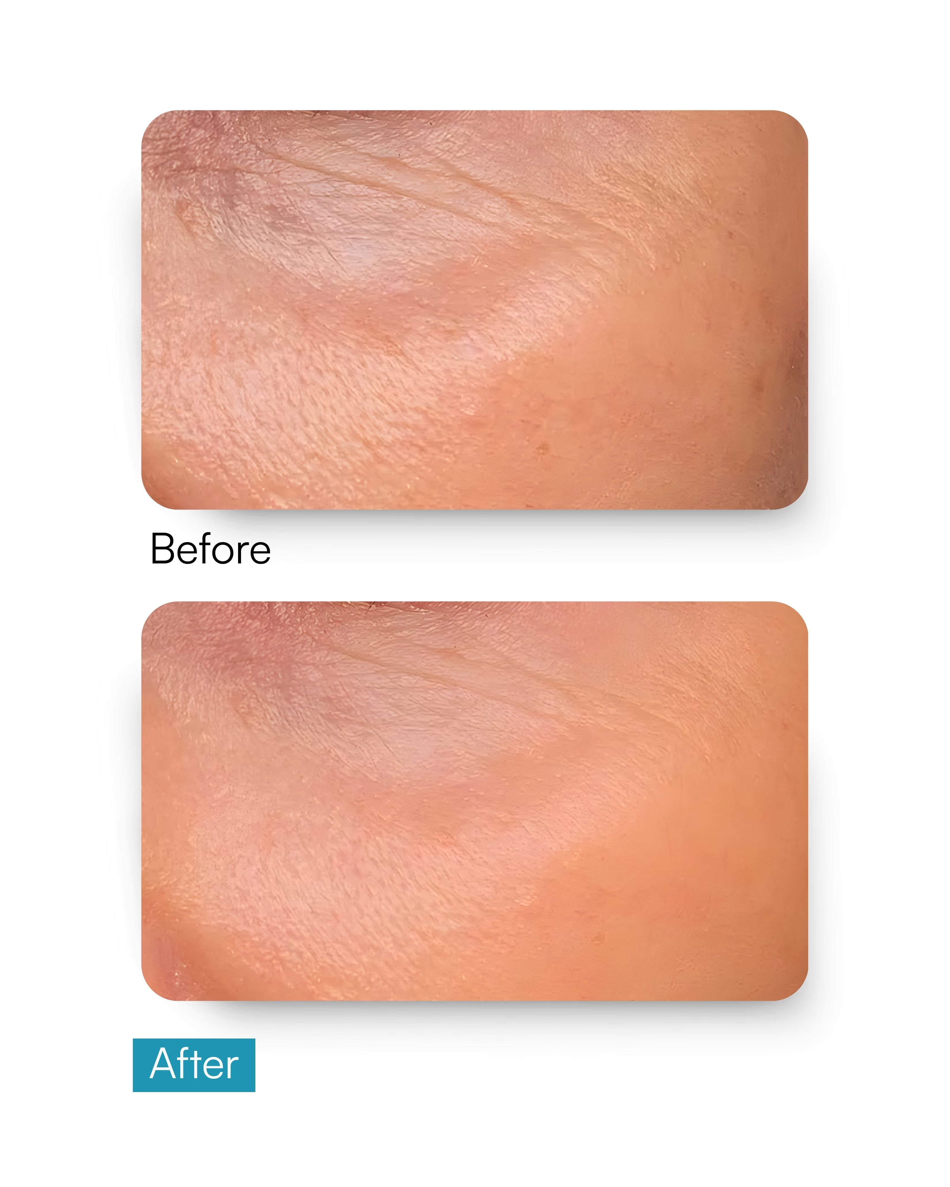 Moisture Lock Serum - Hyaluronic Acid