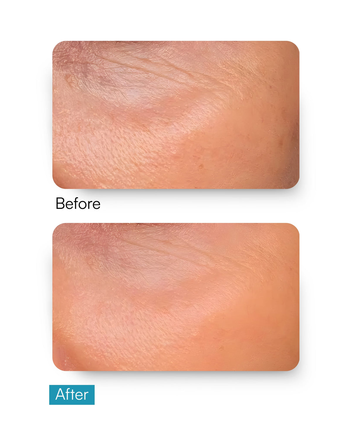Moisture Lock Serum - Hyaluronic Acid